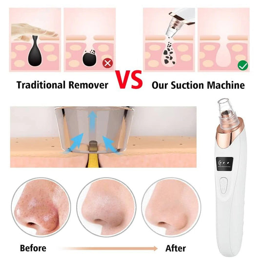 Premium Electric Blackhead Remover & Pore Vacuum Cleaner