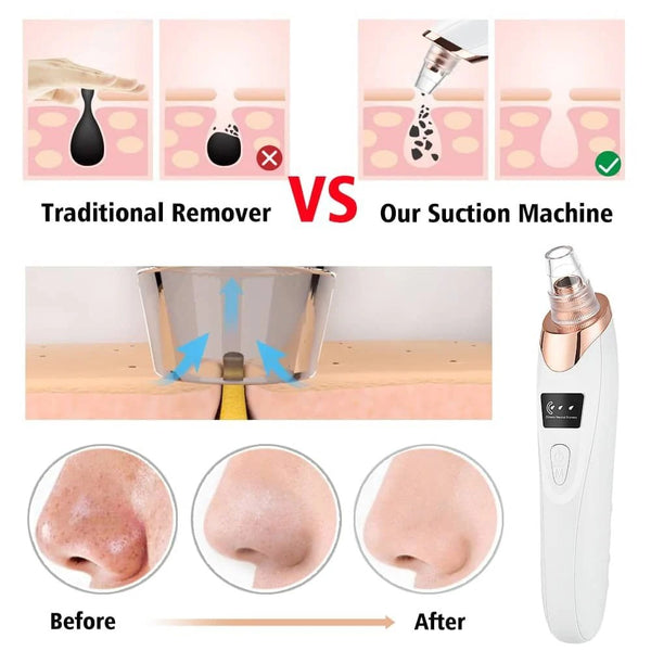 Premium Electric Blackhead Remover & Pore Vacuum Cleaner